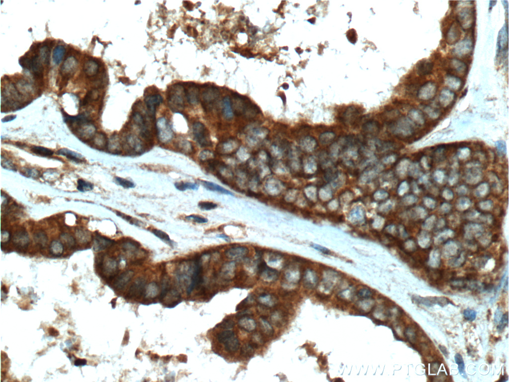 IHC staining of human ovary tumor using 21861-1-AP