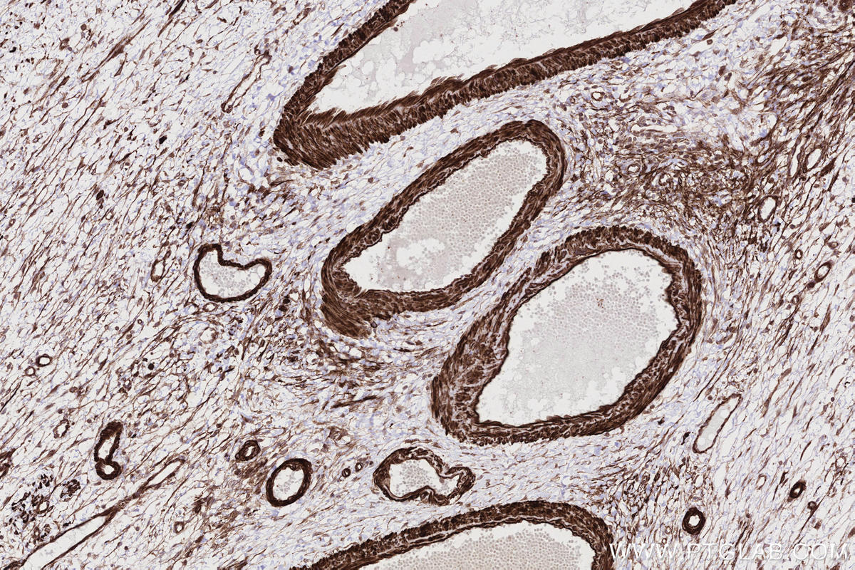 IHC staining of human ovary cancer using 83270-2-RR