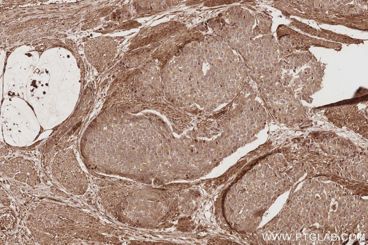 IHC staining of human stomach cancer using 18987-1-AP IHC staining of human stomach cancer using 18987-1-AP