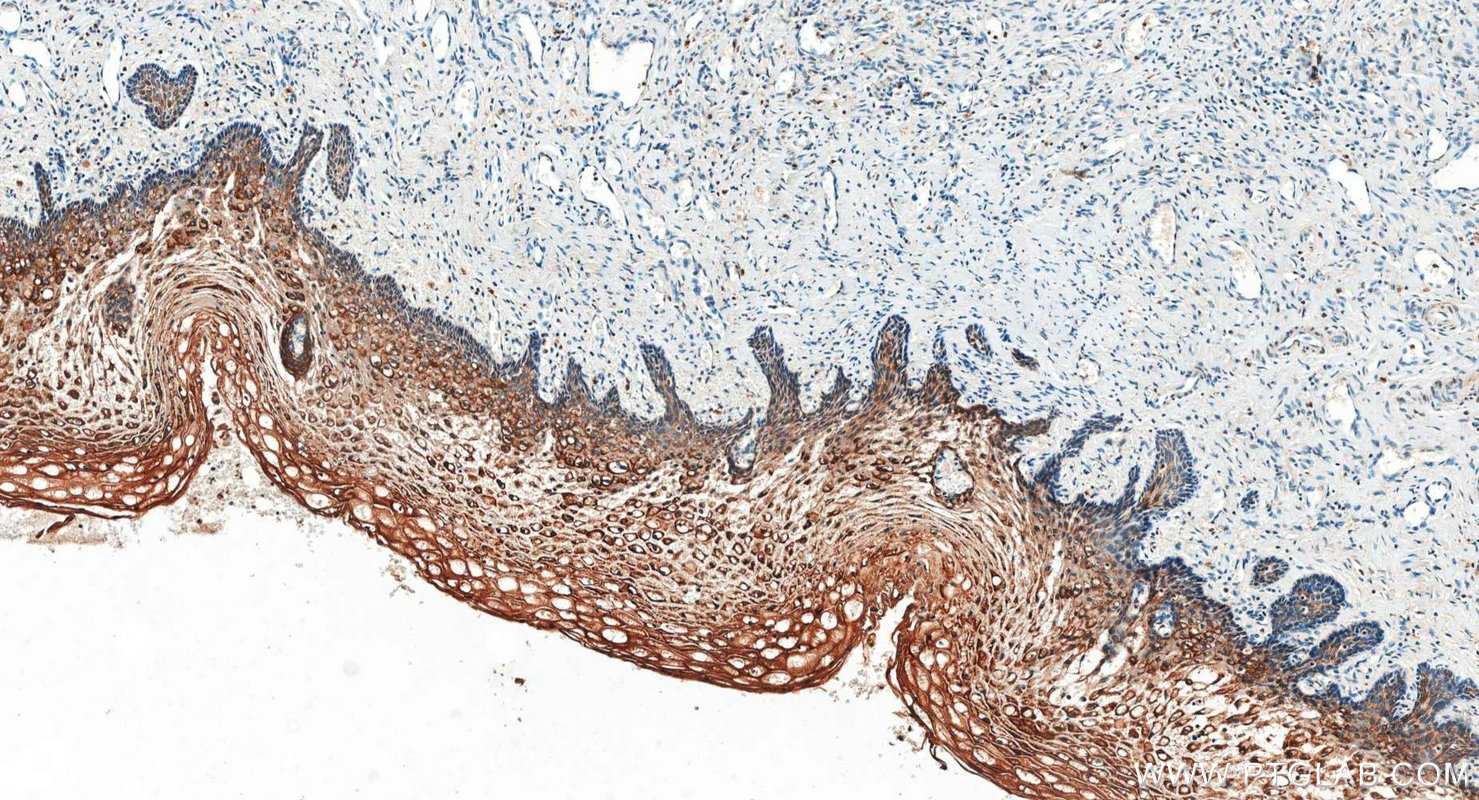 IHC staining of human cervical cancer using 34200-1-AP IHC staining of human cervical cancer using 34200-1-AP