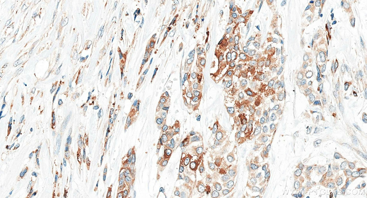 IHC staining of human urothelial carcinoma using 34200-1-AP IHC staining of human urothelial carcinoma using 34200-1-AP