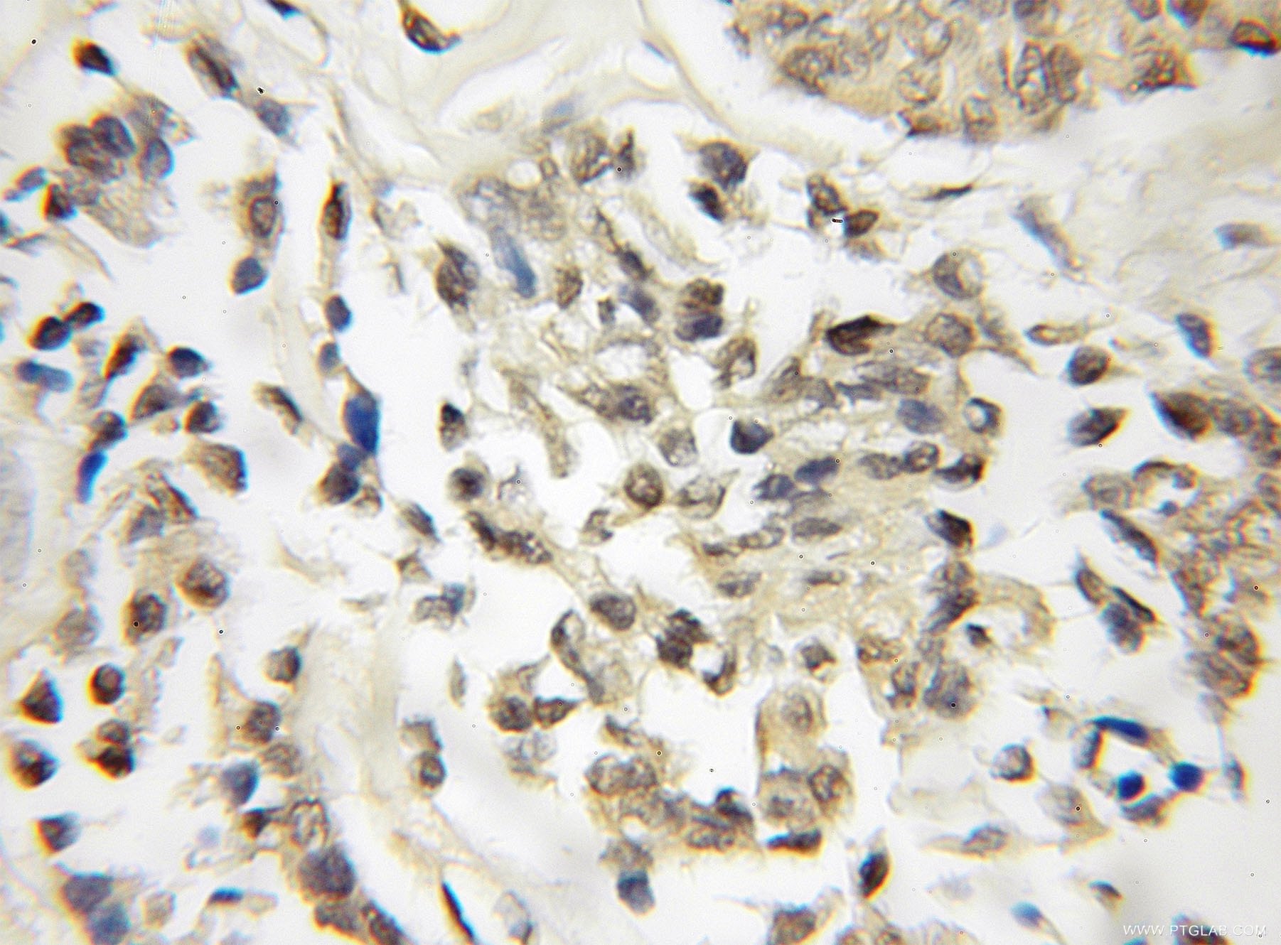 IHC staining of human breast cancer using 11015-2-AP