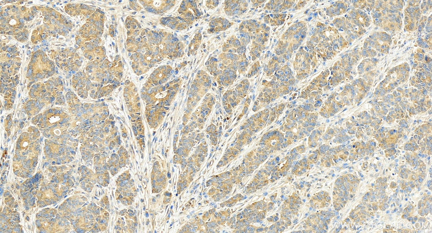 Immunohistochemical analysis of paraffin-embedded human stomach cancer tissue slide using 14866-1-AP (DPH2 antibody) at dilution of 1:200 (under 20x lens). Heat mediated antigen retrieval with Tris-EDTA buffer (pH 9.0). IHC staining of human stomach cancer using 14866-1-AP