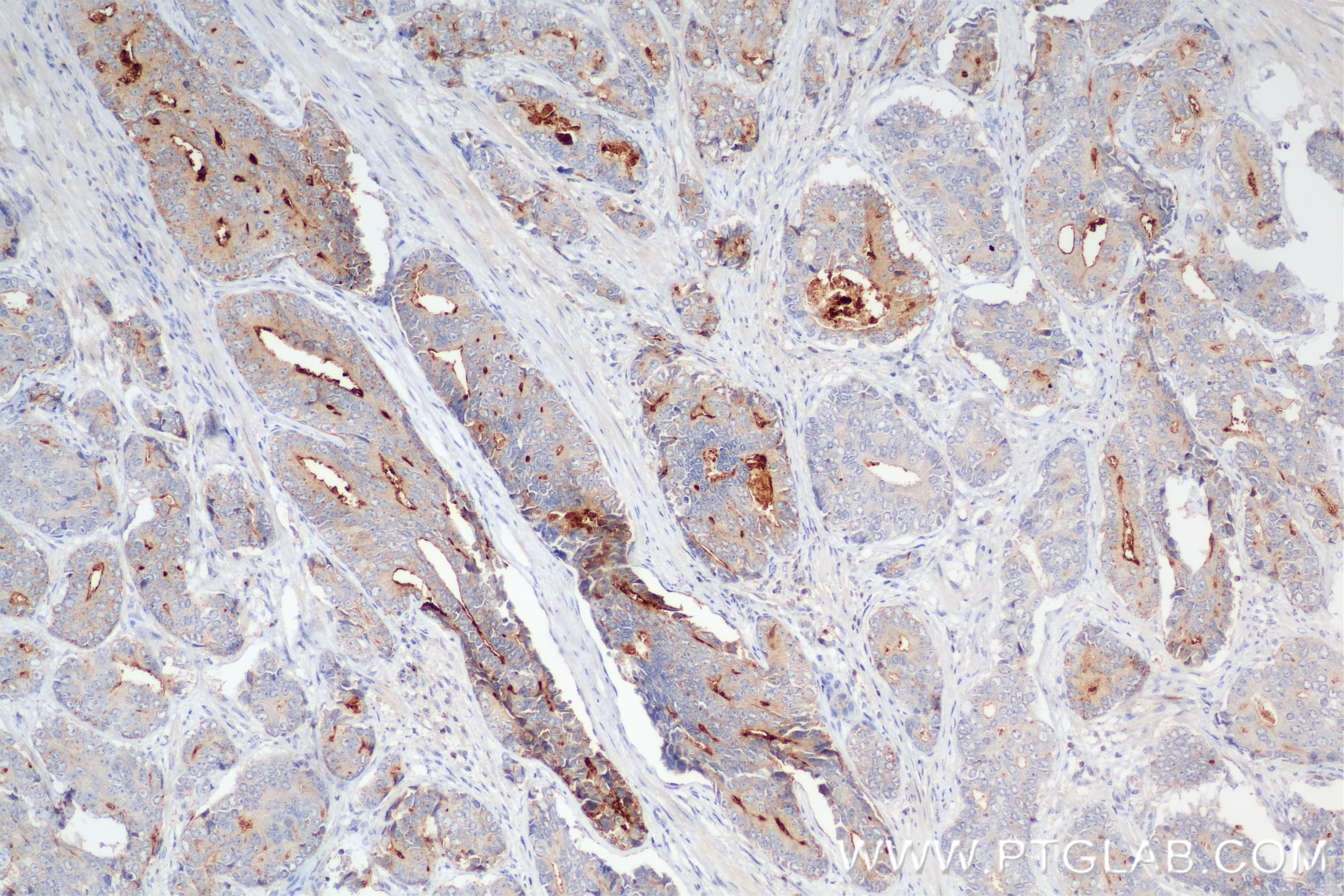 IHC staining of human prostate cancer using 84606-6-RR