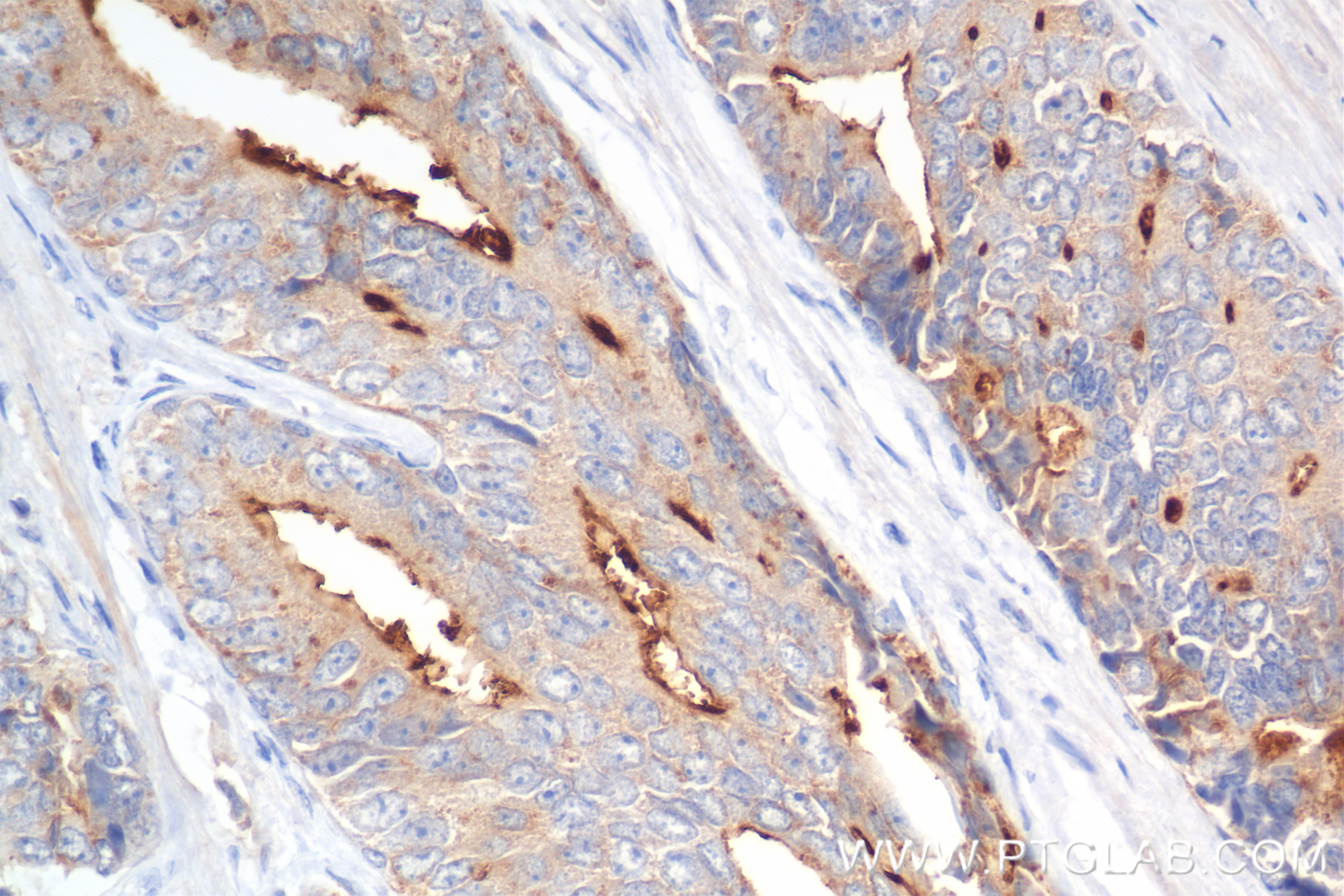 IHC staining of human prostate cancer using 84606-6-RR