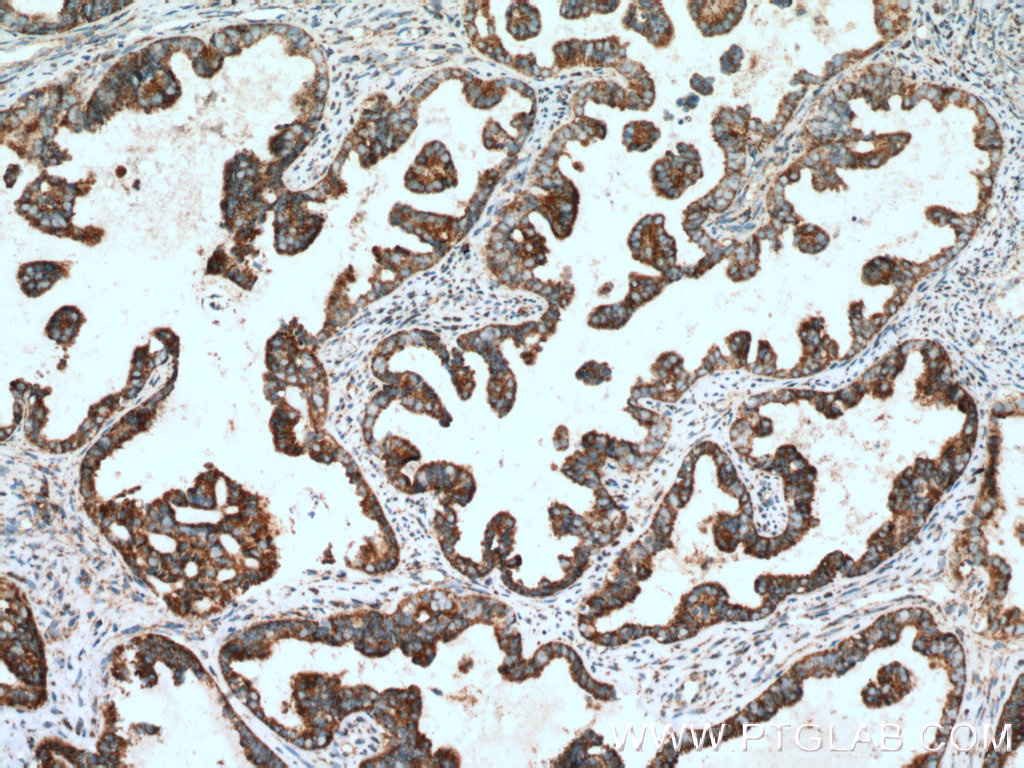 IHC staining of human ovary tumor using 11568-1-AP