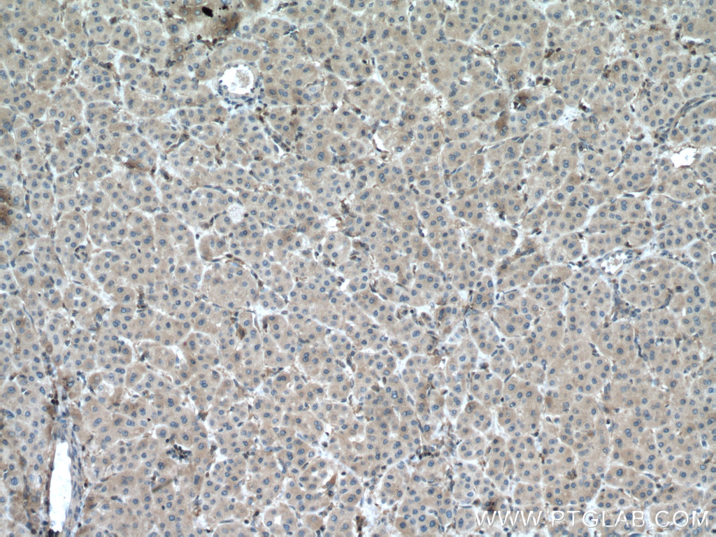 IHC staining of human liver cancer using 27662-1-AP