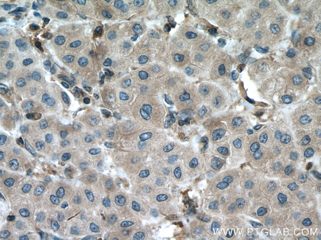 IHC staining of human liver cancer using 27662-1-AP