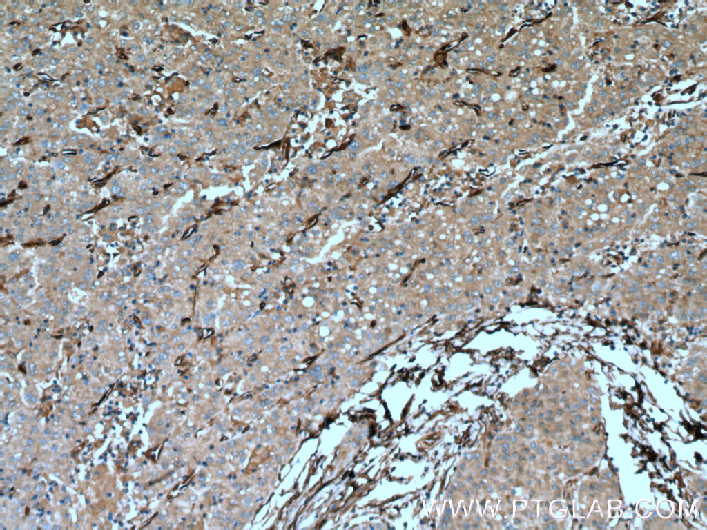 IHC staining of human liver cancer using 18969-1-AP