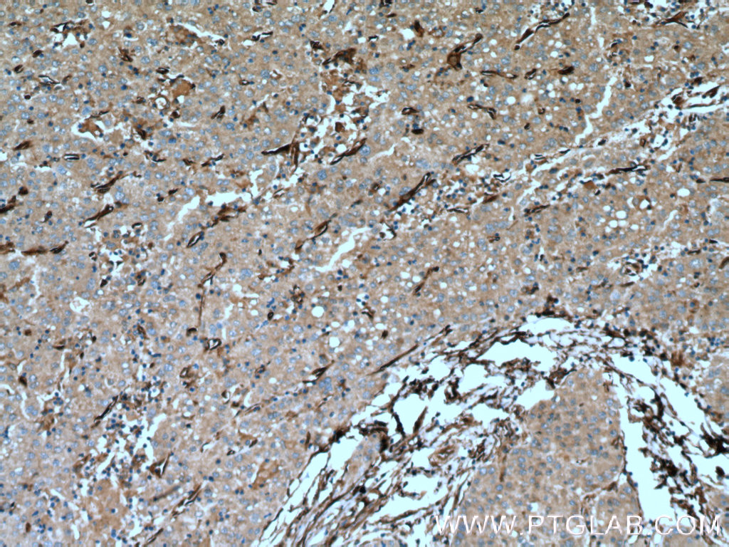 IHC staining of human liver cancer using 18969-1-AP