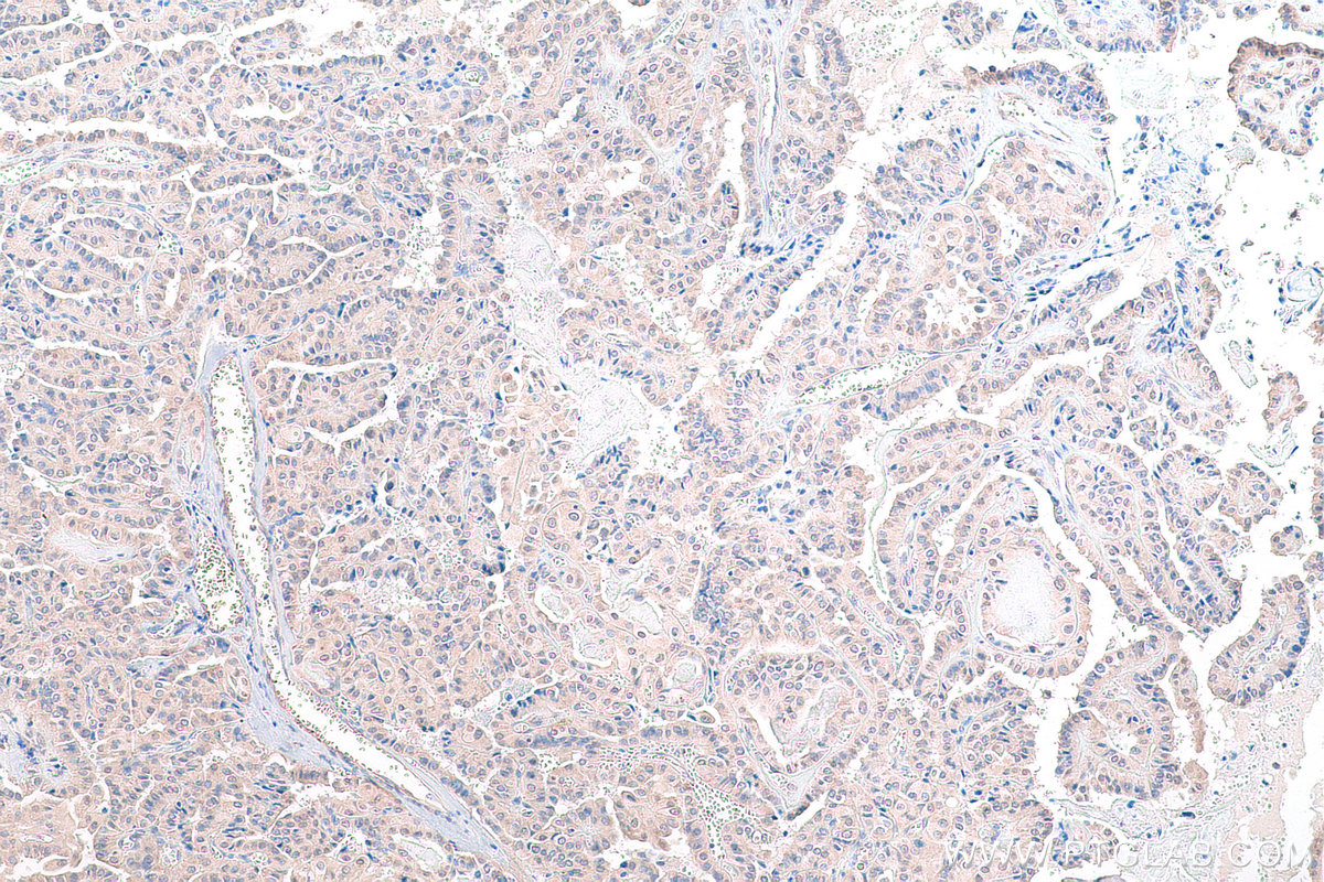 IHC staining of human thyroid cancer using 13190-1-AP