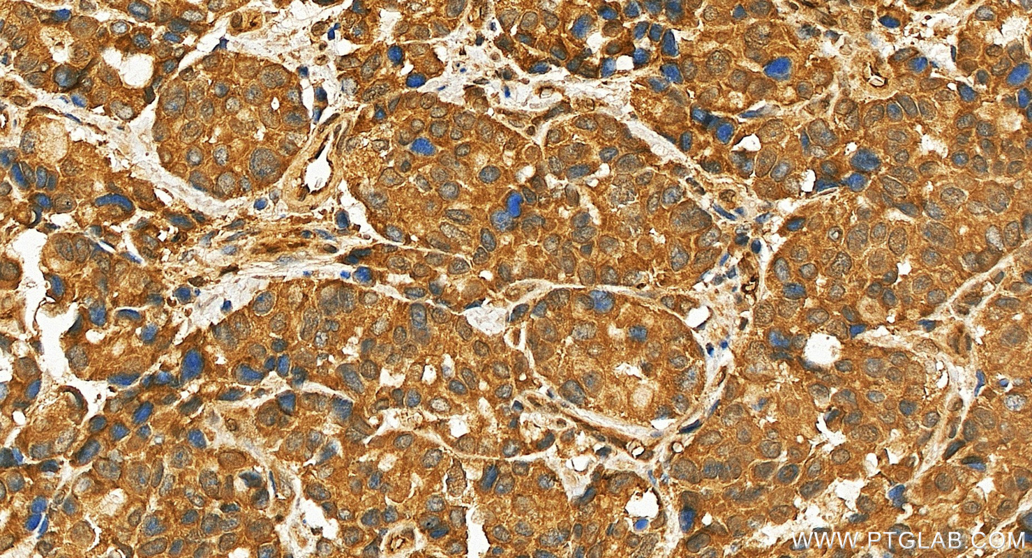 IHC staining of human stomach cancer using 27958-1-AP IHC staining of human stomach cancer using 27958-1-AP