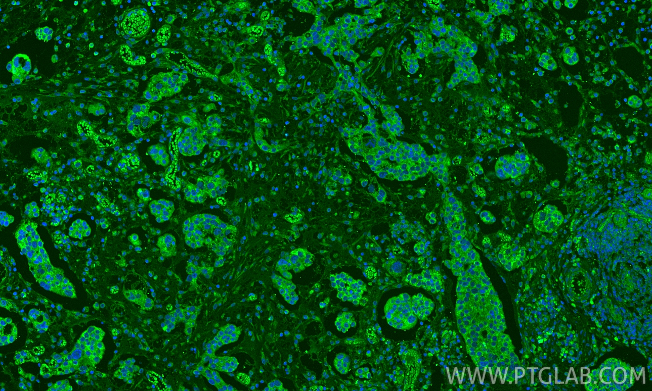 IF Staining of human ovary cancer using 10452-1-AP
