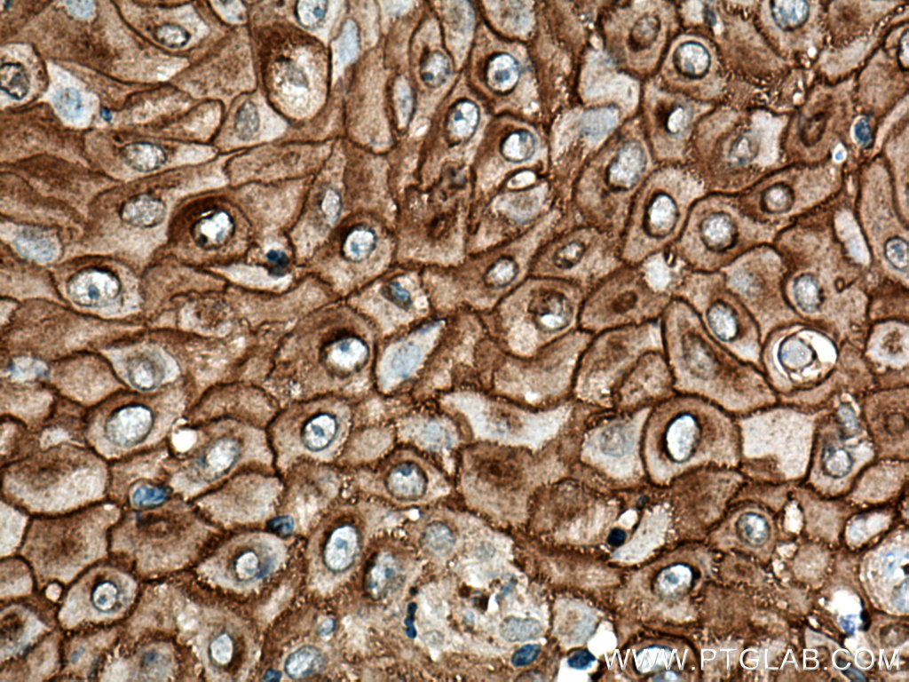 IHC staining of human skin cancer using 24587-1-AP