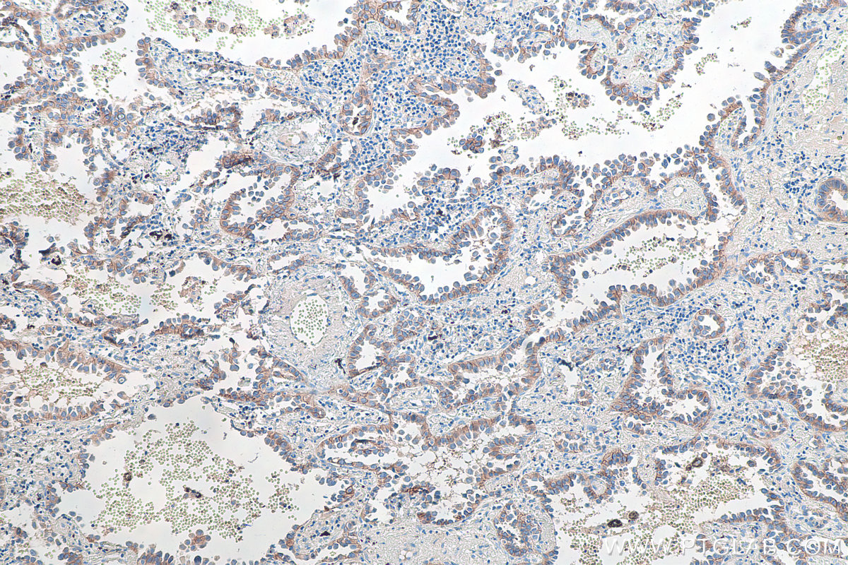 IHC staining of human lung cancer using 21880-1-AP