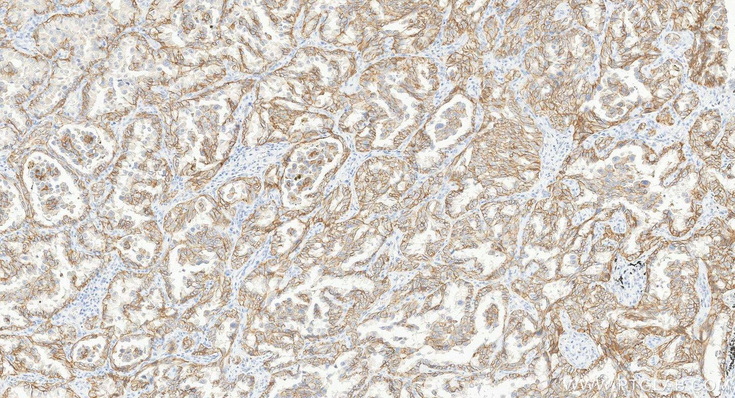 IHC staining of human lung cancer using 21880-1-AP IHC staining of human lung cancer using 21880-1-AP