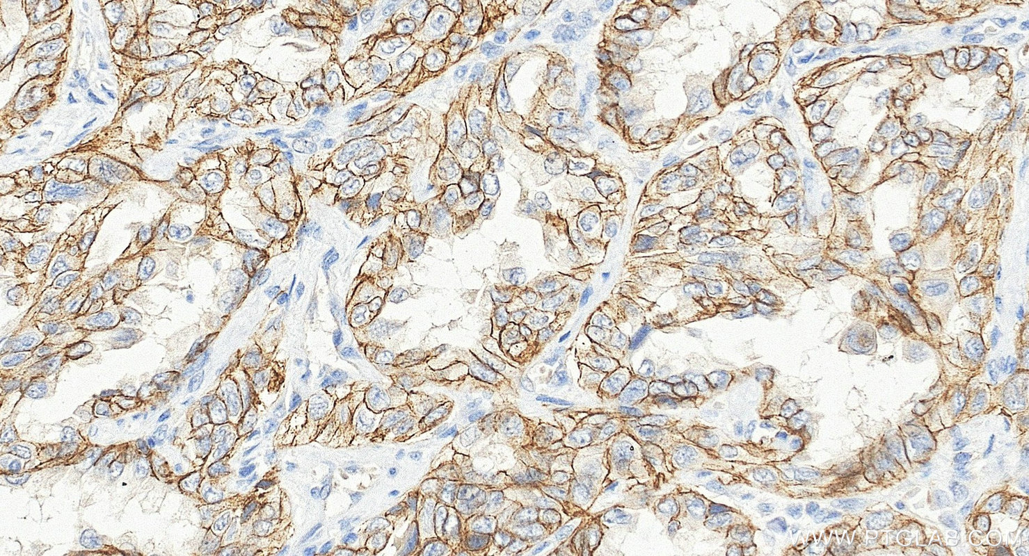IHC staining of human lung cancer using 21880-1-AP IHC staining of human lung cancer using 21880-1-AP
