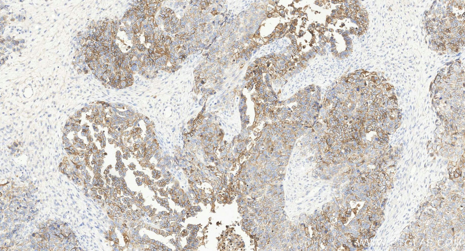 IHC staining of human ovary cancer using 21880-1-AP IHC staining of human ovary cancer using 21880-1-AP