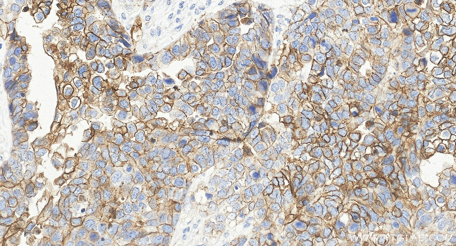 IHC staining of human ovary cancer using 21880-1-AP IHC staining of human ovary cancer using 21880-1-AP