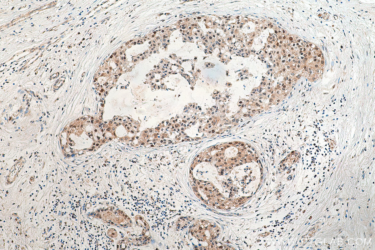IHC staining of human breast cancer using 17742-1-AP (same clone as 17742-1-PBS)