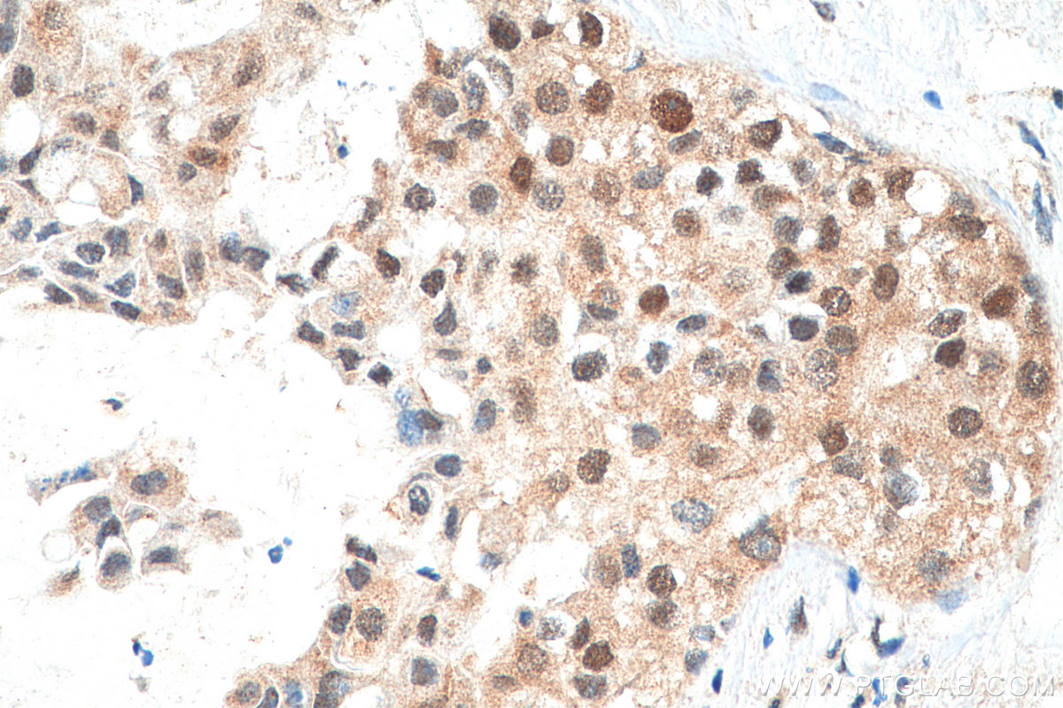 IHC staining of human breast cancer using 17742-1-AP (same clone as 17742-1-PBS)