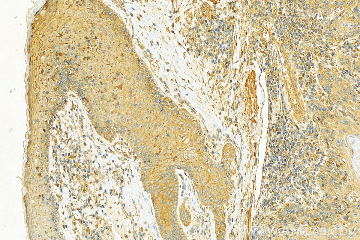 IHC staining of human skin cancer using 10962-2-AP