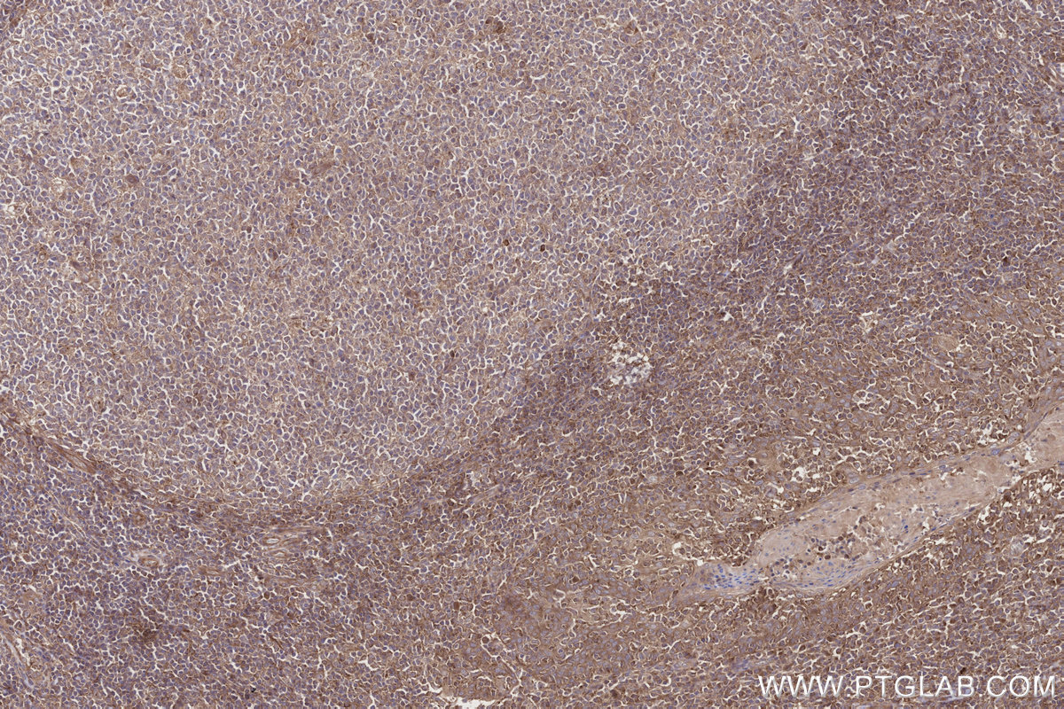IHC staining of human tonsillitis using 11963-1-AP IHC staining of human tonsillitis using 11963-1-AP
