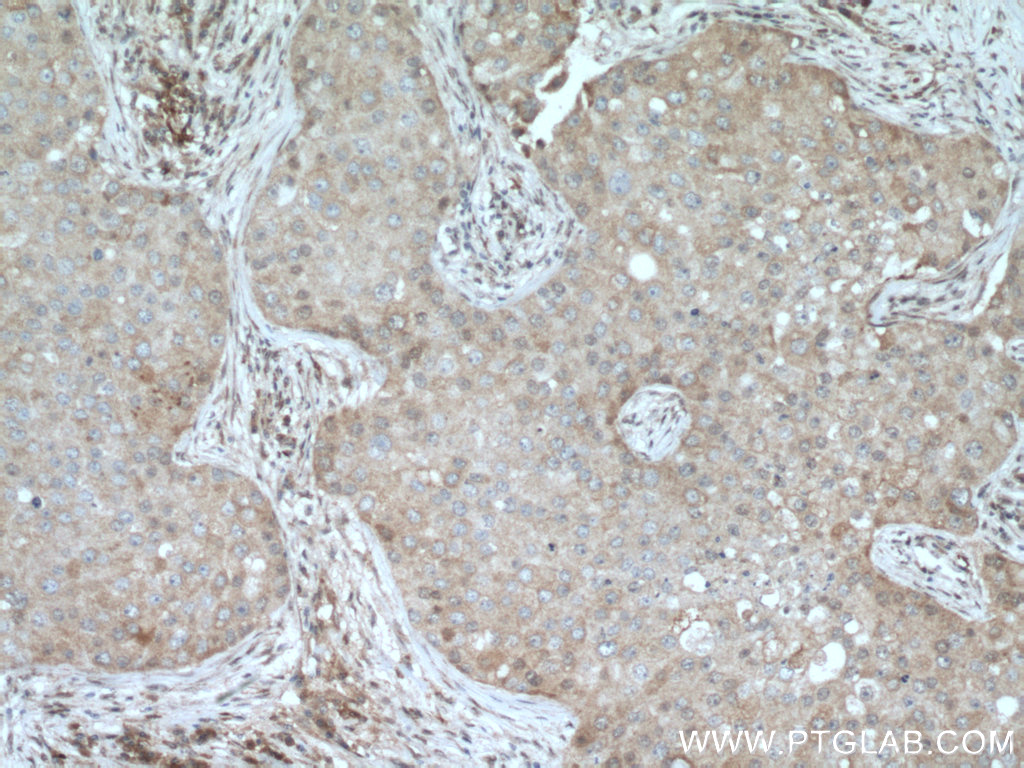 IHC staining of human breast cancer using 15643-1-AP