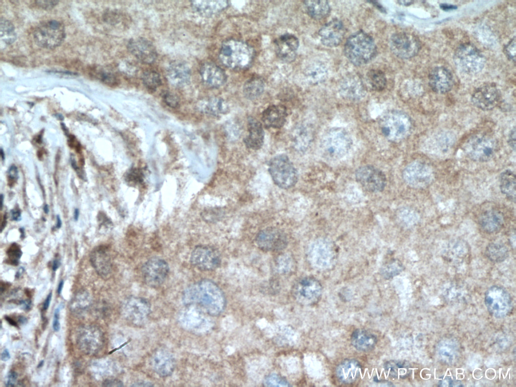 IHC staining of human breast cancer using 15643-1-AP