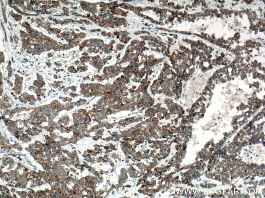 IHC staining of human colon cancer using 10909-1-AP