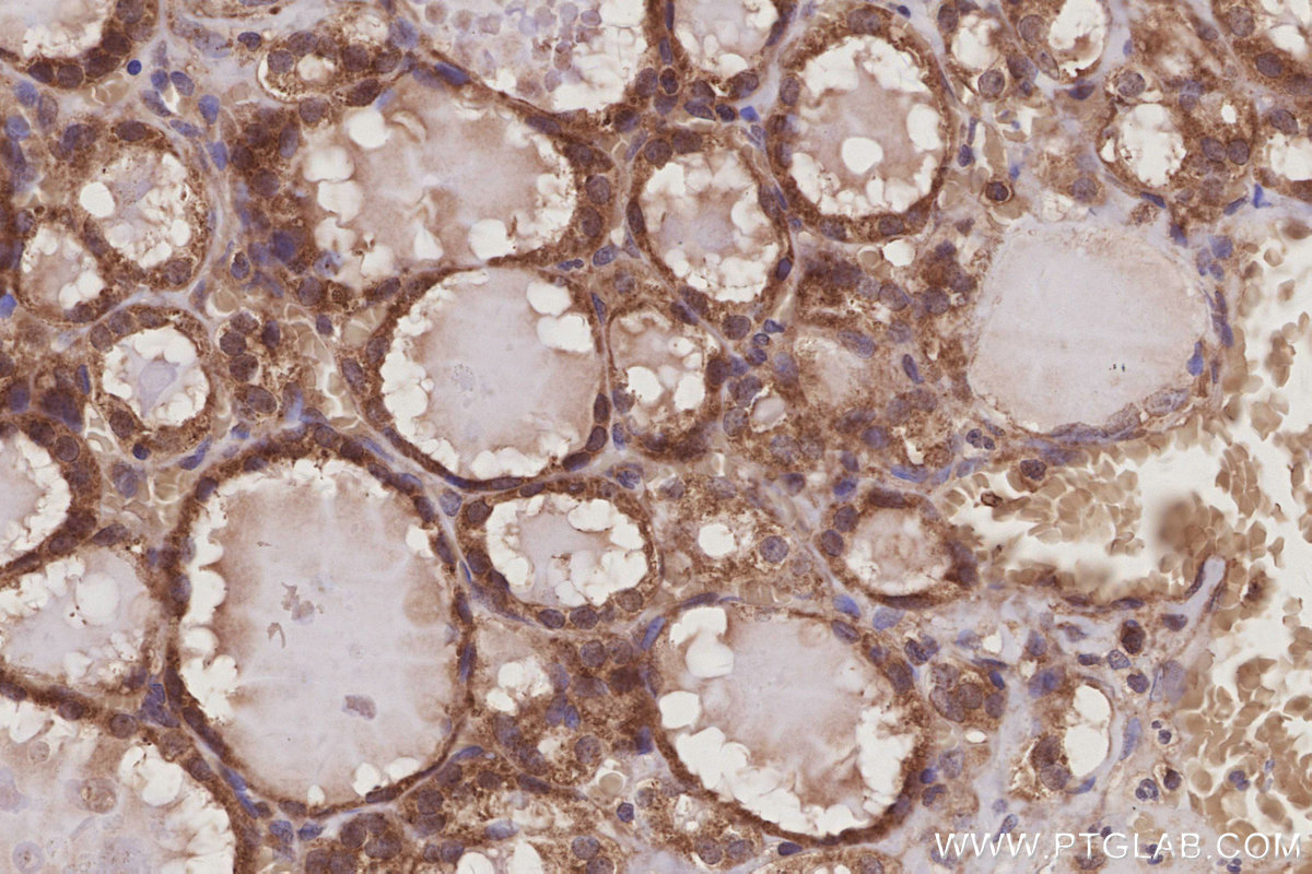 IHC staining of human thyroid cancer using 10909-1-AP