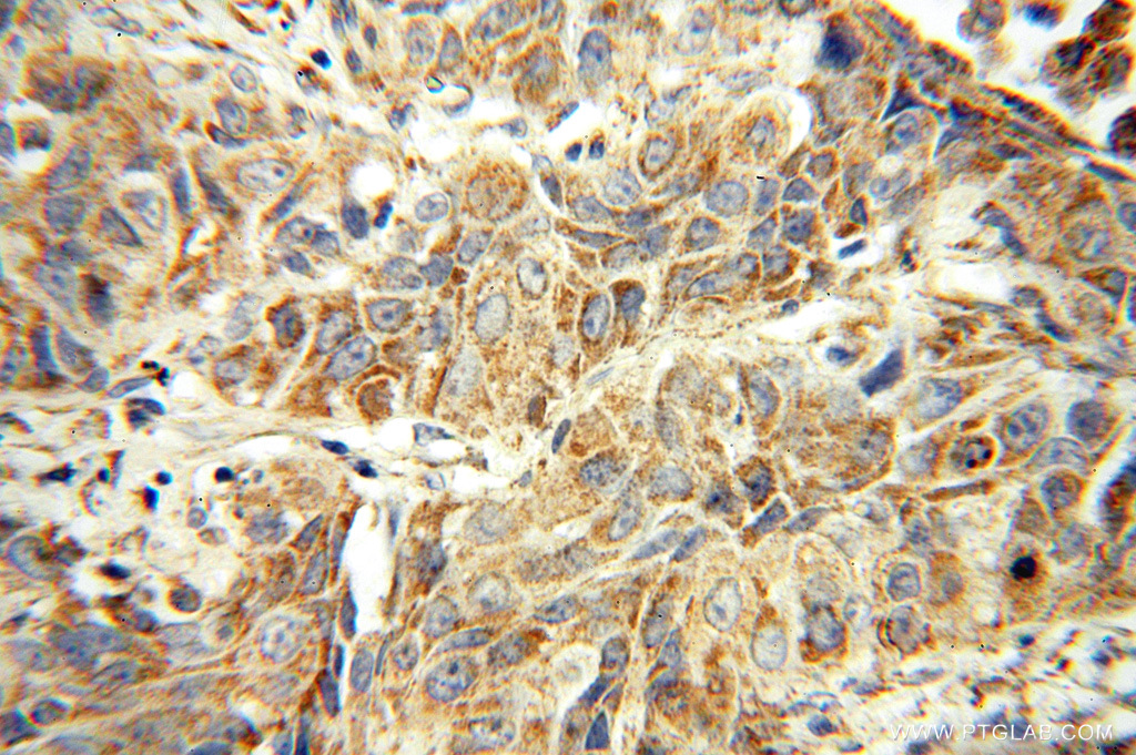 IHC staining of human lung cancer using 16514-1-AP