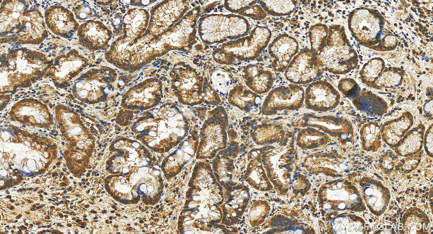 IHC staining of human stomach cancer using 28284-1-AP
