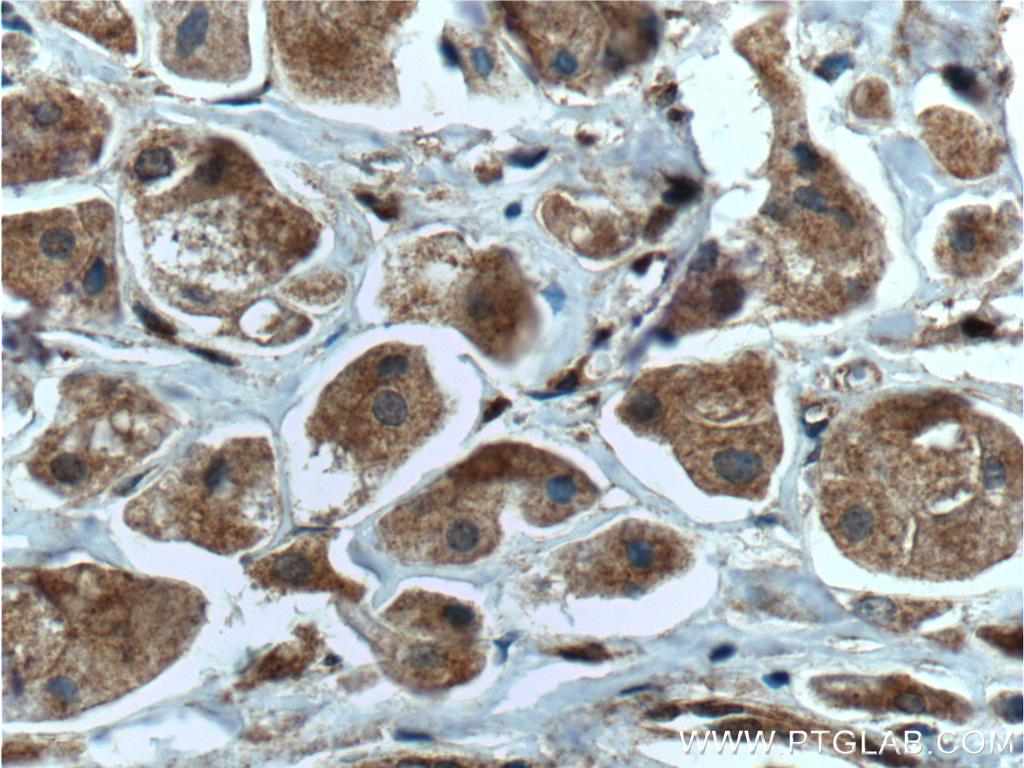 IHC staining of human breast cancer using 26910-1-AP