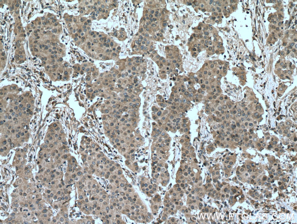 IHC staining of human breast cancer using 26718-1-AP