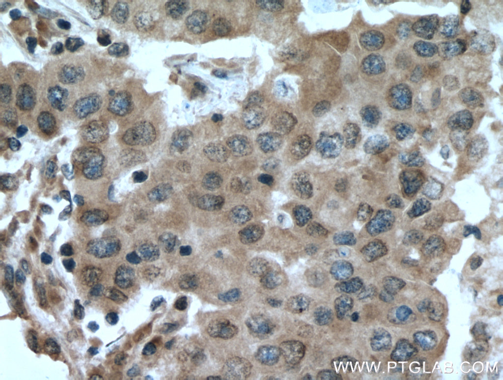 IHC staining of human breast cancer using 26718-1-AP