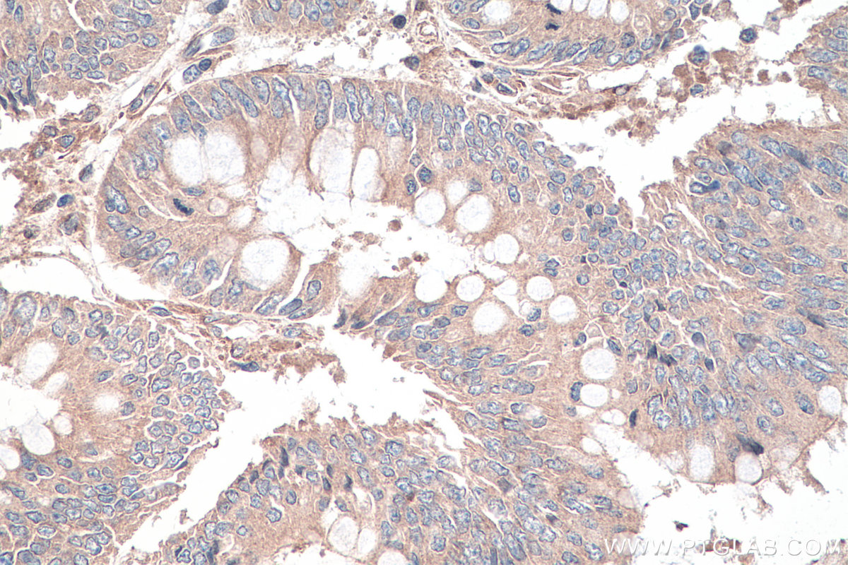 IHC staining of human colon cancer using 13444-1-AP