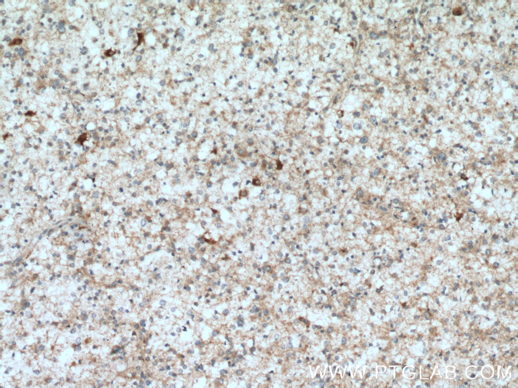 IHC staining of human gliomas using 13808-1-AP