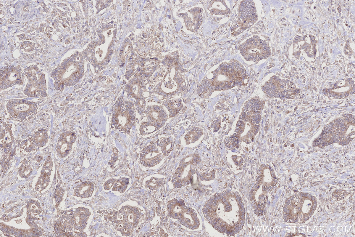 IHC staining of human rectal cancer using 21979-1-AP IHC staining of human rectal cancer using 21979-1-AP