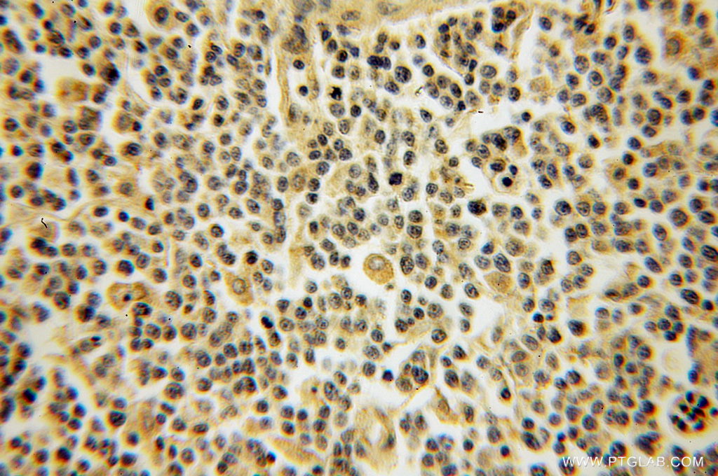 IHC staining of human lymphoma using 12890-2-AP (same clone as 12890-2-PBS)