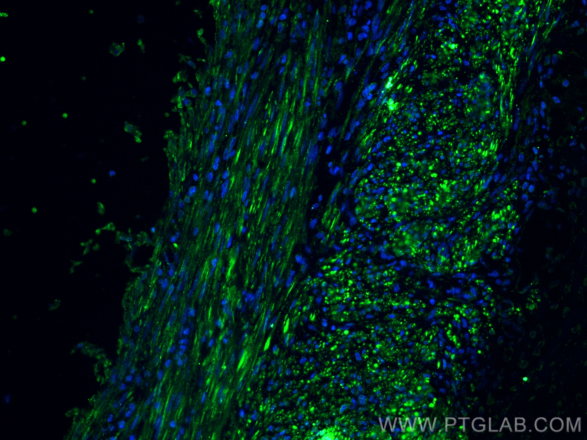 IF Staining of human appendicitis using 67793-1-Ig