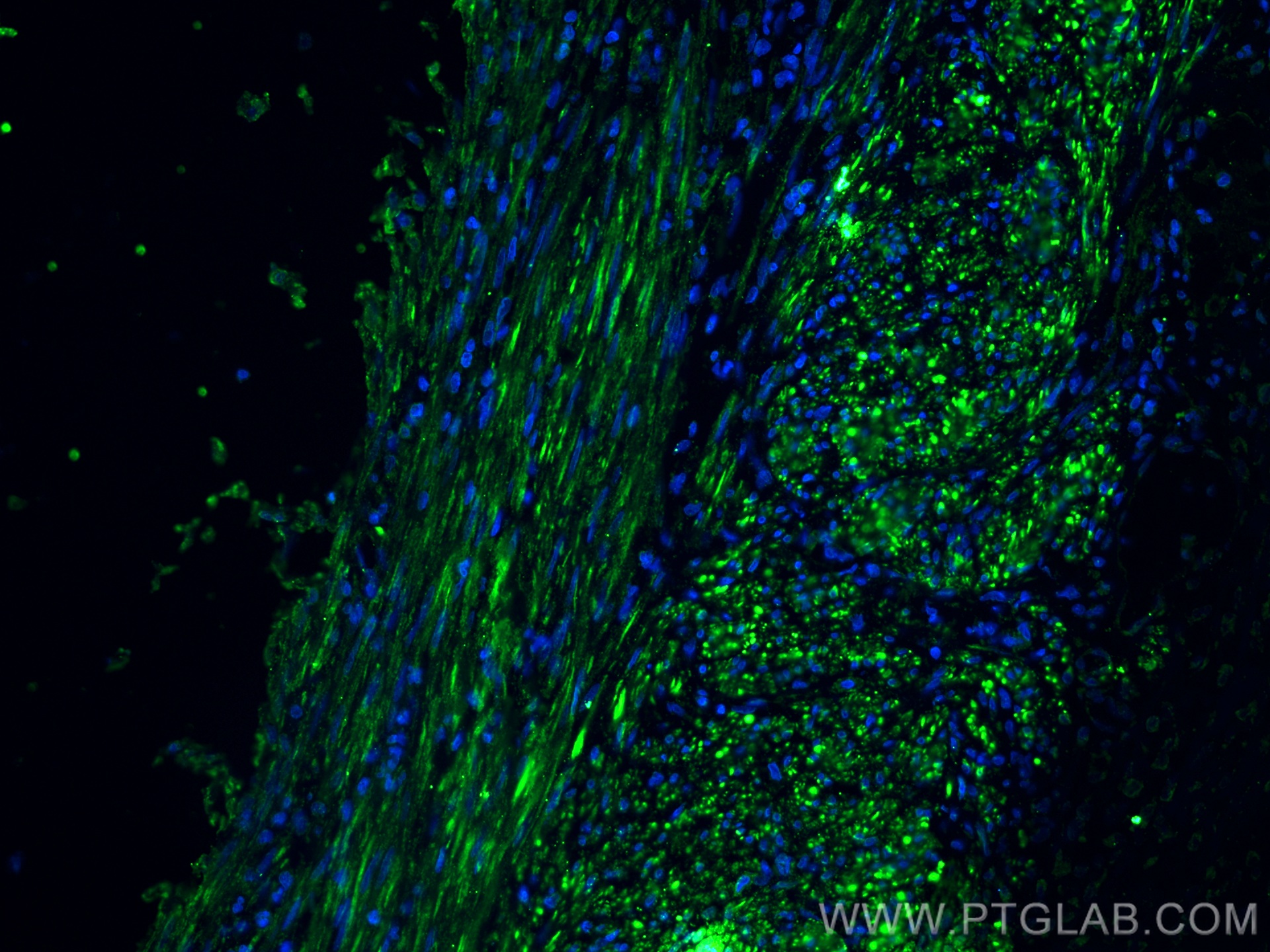 IF Staining of human appendicitis using 67793-1-Ig (same clone as 67793-1-PBS)