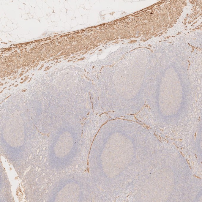 IHC staining of human appendicitis using 67793-1-Ig IHC staining of human appendicitis using 67793-1-Ig