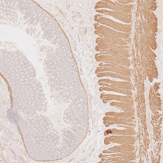 IHC staining of human colorectal cancer using 67793-1-Ig IHC staining of human colorectal cancer using 67793-1-Ig