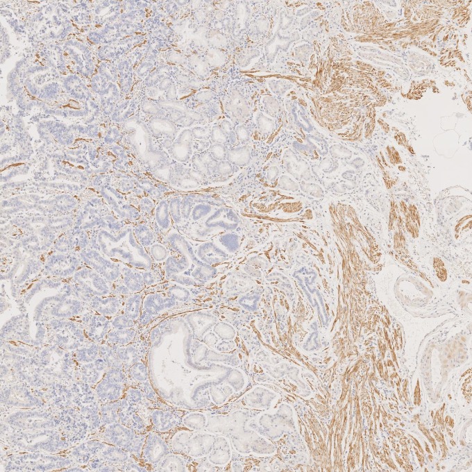 IHC staining of human stomach cancer using 67793-1-Ig IHC staining of human stomach cancer using 67793-1-Ig