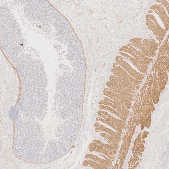 IHC staining of human colorectal cancer using 67793-1-Ig IHC staining of human colorectal cancer using 67793-1-Ig