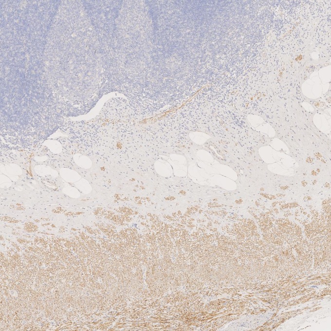 IHC staining of human appendicitis using 67793-1-Ig IHC staining of human appendicitis using 67793-1-Ig