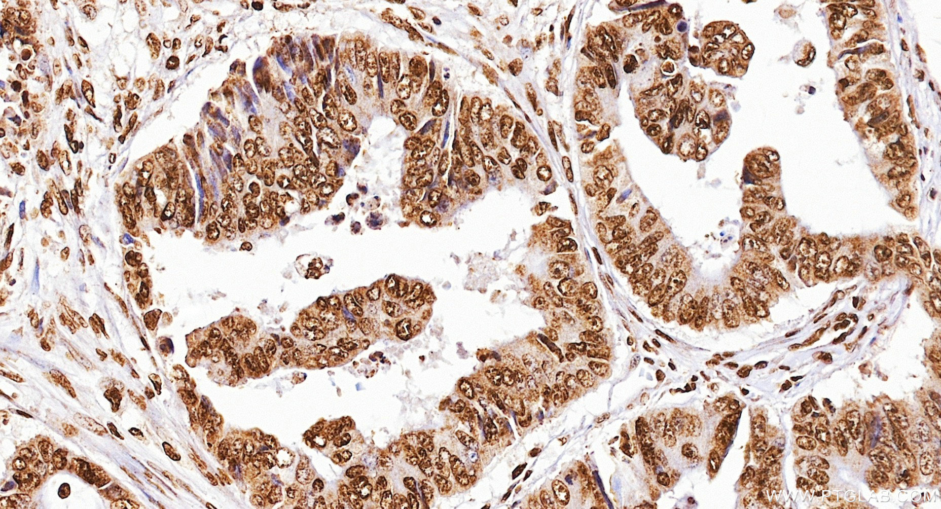 IHC staining of human colon cancer using 86990-2-RR (same clone as 86990-2-PBS)