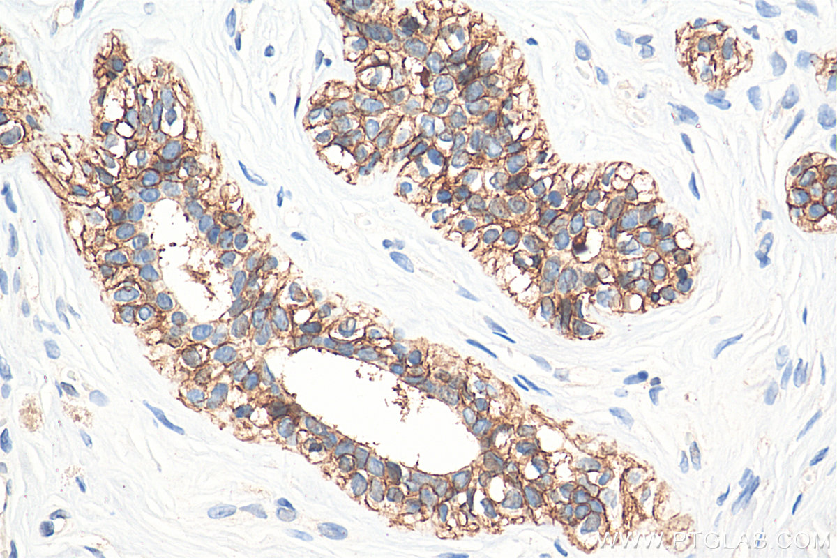 IHC staining of human breast cancer using 20874-1-AP