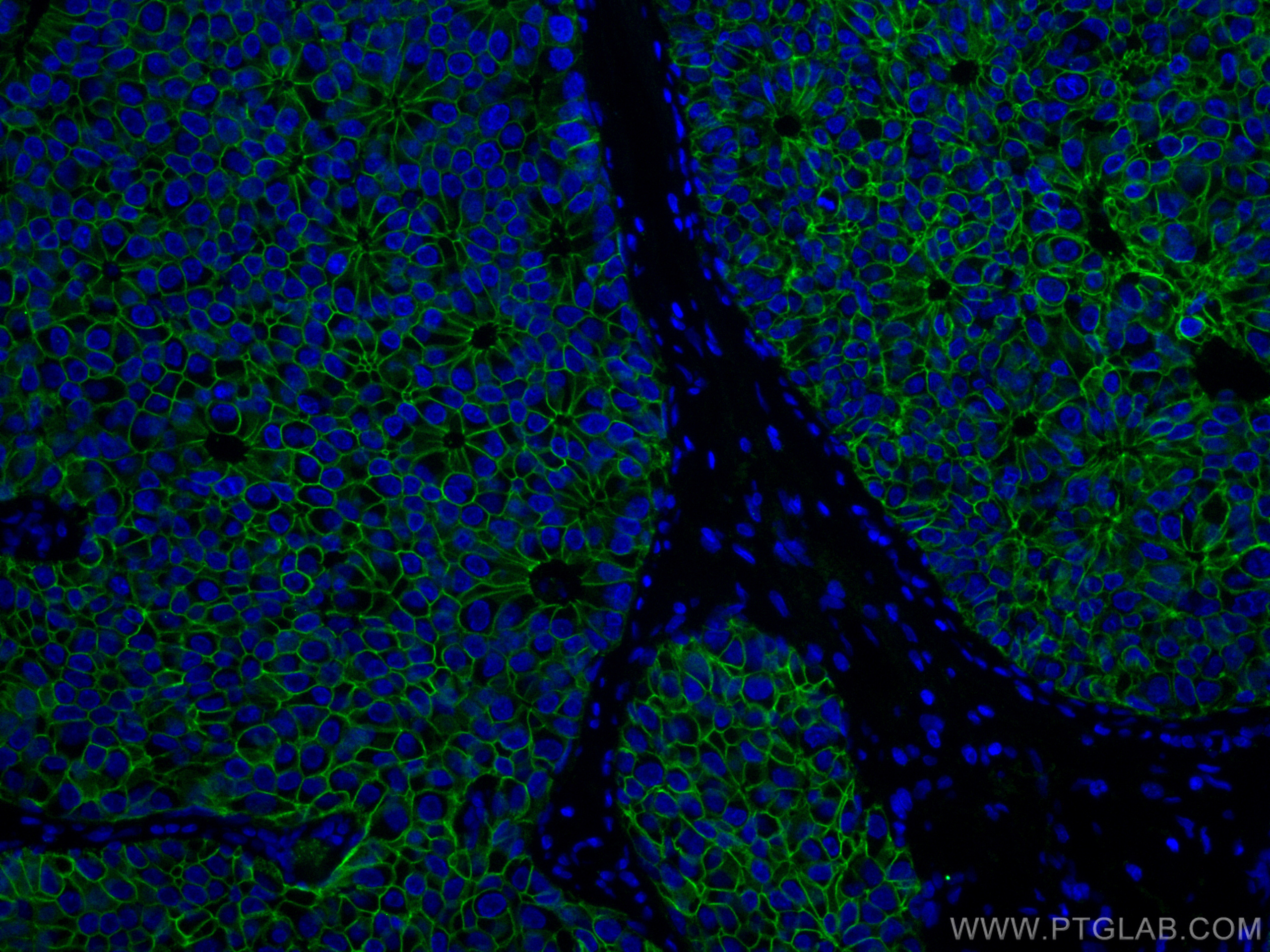 IF Staining of human breast cancer using 60335-1-Ig (same clone as 60335-1-PBS)